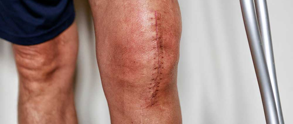 Man,On,Crutches,After,Knee,Replacement,Surgery,,Stitches,Close,Up.