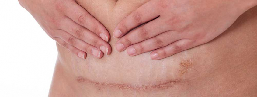 Scar,From,A,C-section,Birth,On,A,Whire,Background.